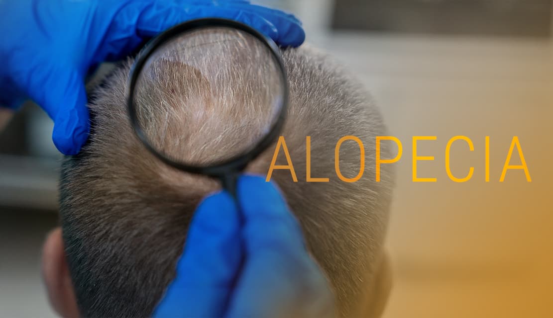 Entendiendo la Alopecia: Tratamientos que Funcionan