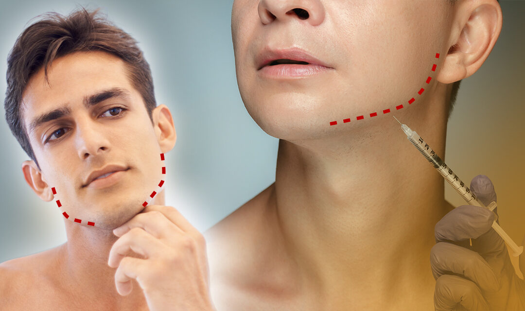 Masseter Botox for Jawline Slimming: The Ultimate Guide