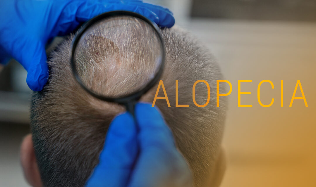 Understanding Alopecia: Treatments That Work